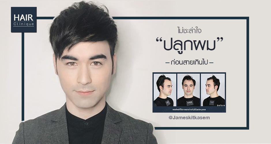 หัวล้านอายุน้อย