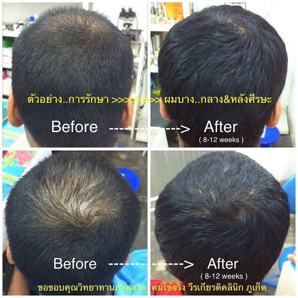 ปลูกผมภูเก็ต