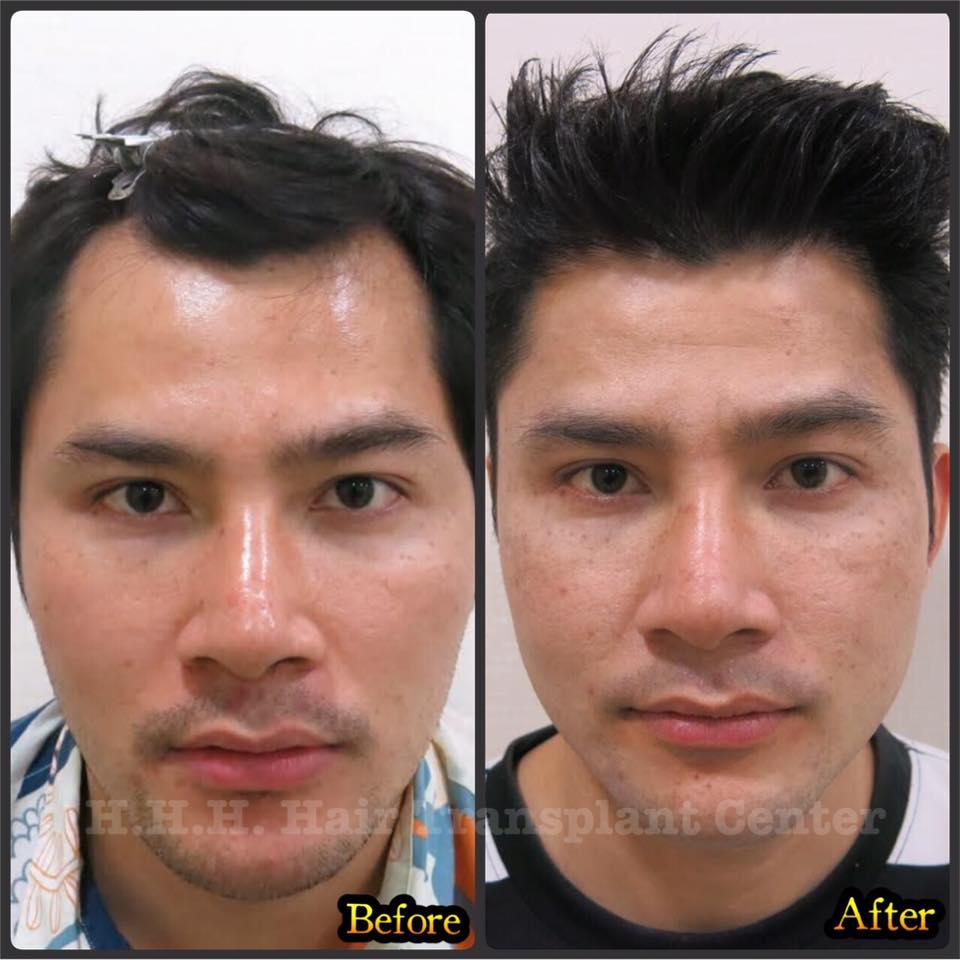 ปลูกผมรีวิว