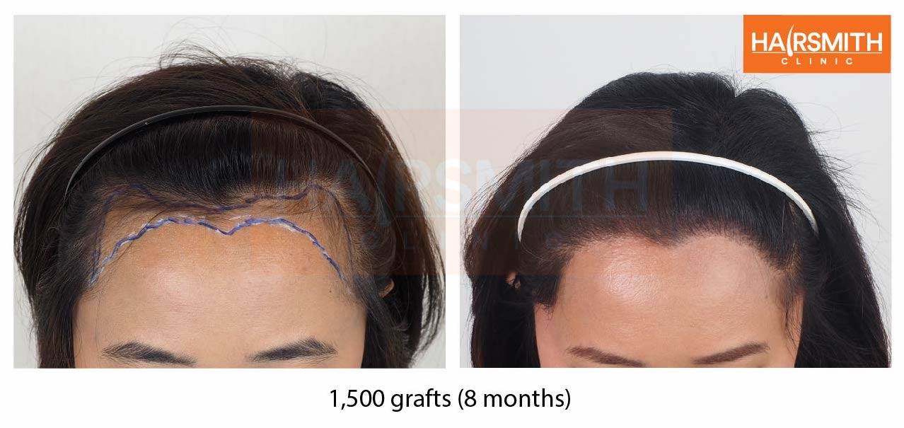 รีวิวคลินิกปลูกผม