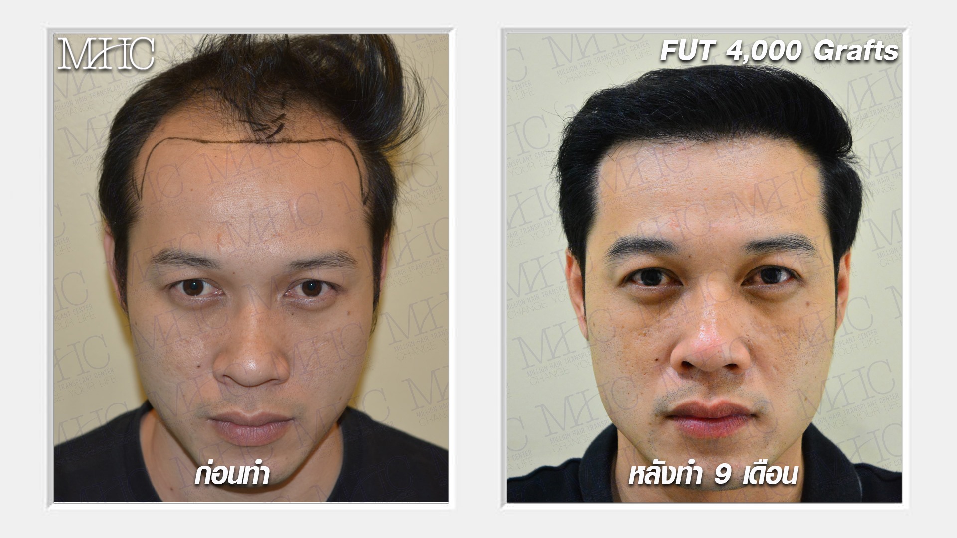 รีวิวปลูกผม