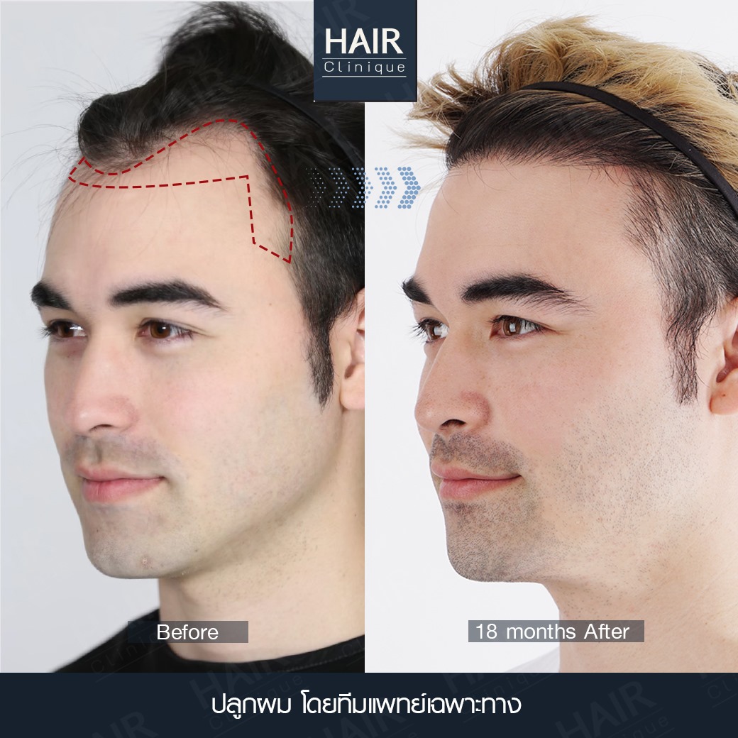 คลีนิคปลูกผม