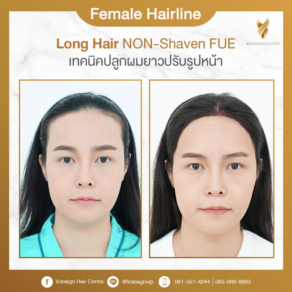 รีวิวคลินิกปลูกผม