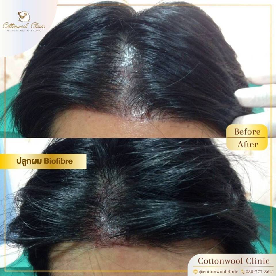 รีวิวปลูกผม