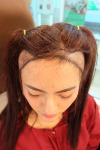 ค่าใช้จ่ายในการปลูกผม