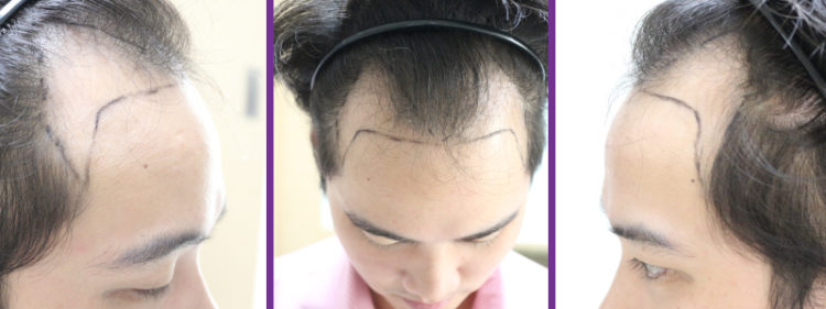 ค่าใช้จ่ายในการปลูกผม